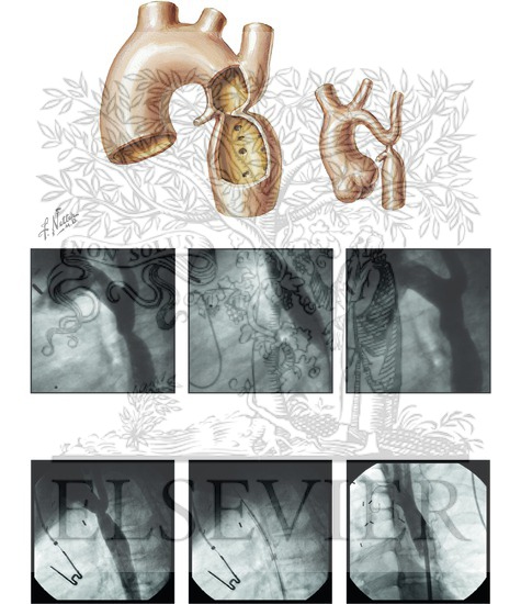 Coarctation of the Aorta