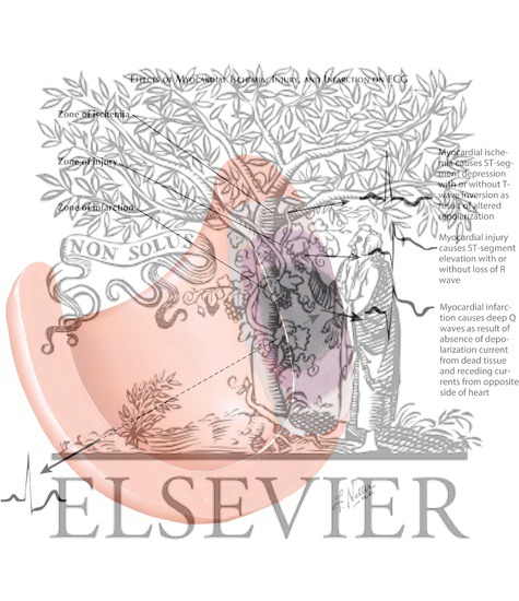 Watermarked preview of labeled image: Effects of Myocardial Ischemia, Injury and Infarction on ECG