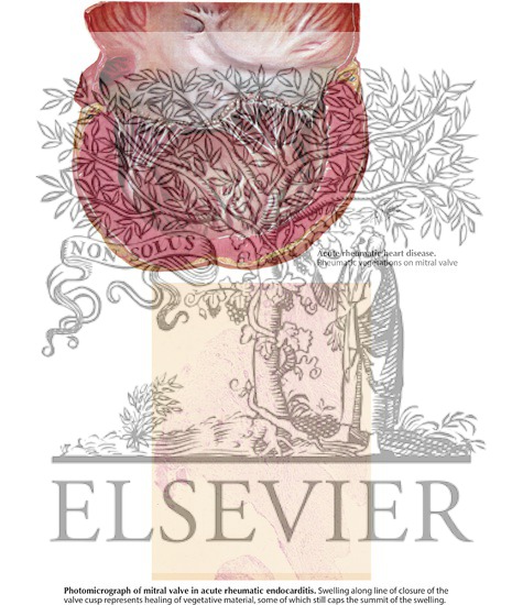 Watermarked preview of labeled image: Rheumatic Heart Disease