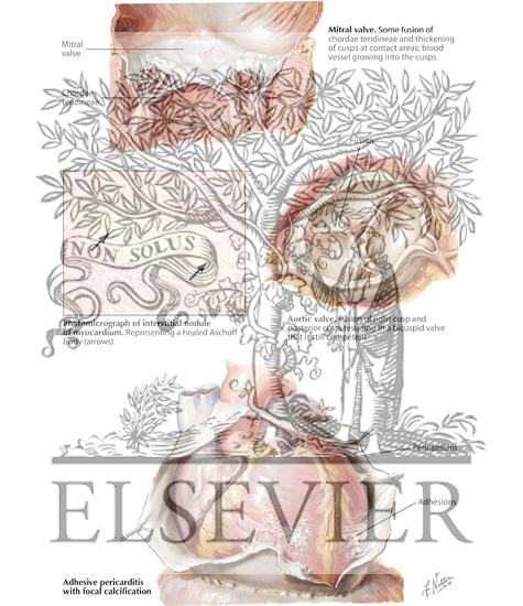 Watermarked preview of labeled image: Rheumatic Heart Disease III-Residual Changes of Acute Rheumatic Carditis