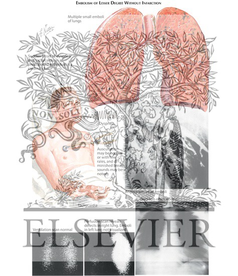 Embolism of Lesser Degree Without Infarction