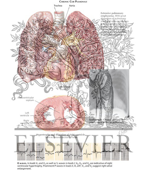 Watermarked preview of labeled image: Chronic Cor Pulmonale