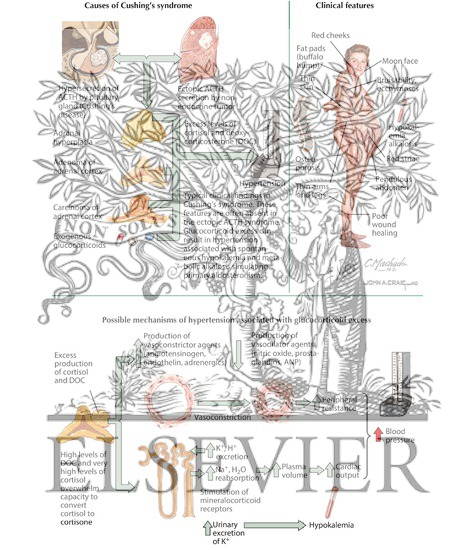 Watermarked preview of labeled image: Cushing's Syndrome and ...