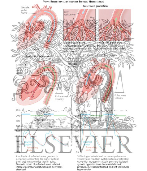 Watermarked preview of labeled image: Wave Reflection and Isolated Systolic Hypertension