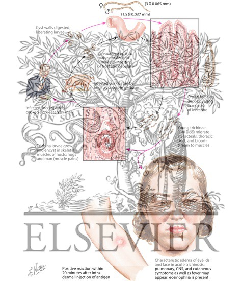 Watermarked preview of labeled image: Trichinosis