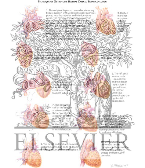 Watermarked preview of labeled image: Technique of Biatrial Cardiac Transplantation