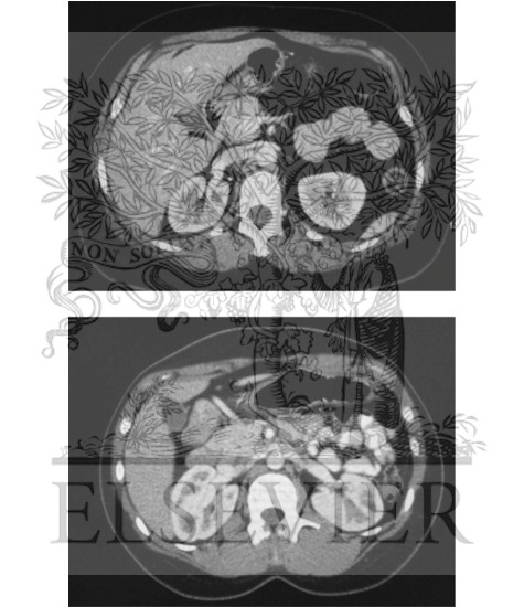 Watermarked preview of unlabeled image: Abdominal Scans:  Axial CT Images (Continued)