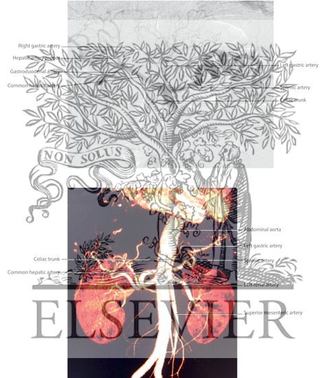 Watermarked preview of labeled image: Celiac Arteriogram and CT Angiogram