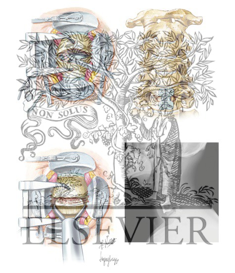 Watermarked preview of unlabeled image: Anterior Cervical Spine Decompression and Stabilization