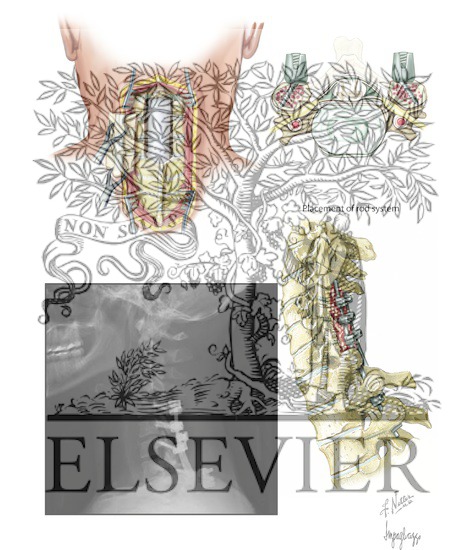 Watermarked preview of unlabeled image: Posterior Cervical Stabilization and Fusion