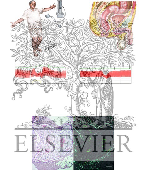 Watermarked preview of unlabeled image: Monoclonal Protein Associated Neuropathies: Amyloid Neuropathy