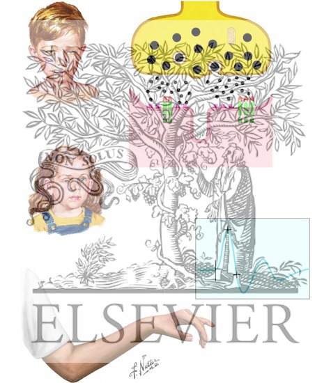 Watermarked preview of unlabeled image: Congenital Myasthenic Syndromes