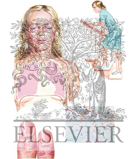 Watermarked preview of unlabeled image: Polymyositis and Dermatomyositis