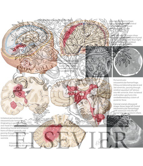 Watermarked preview of labeled image: Intracranial Hemorrhage in Newborn