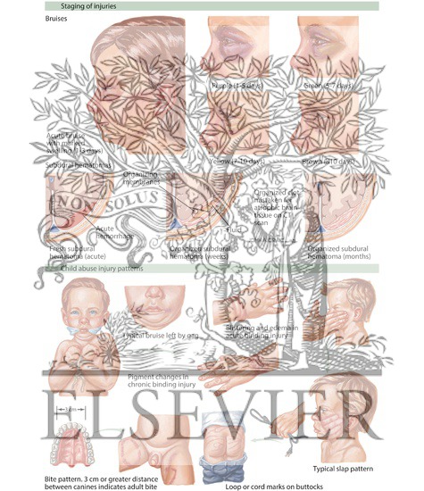 Watermarked preview of labeled image: Child Abuse: Staging of Injuries and Injury Patterns