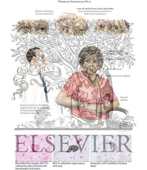 Watermarked preview of labeled image: Progressive Supranuclear Palsy
