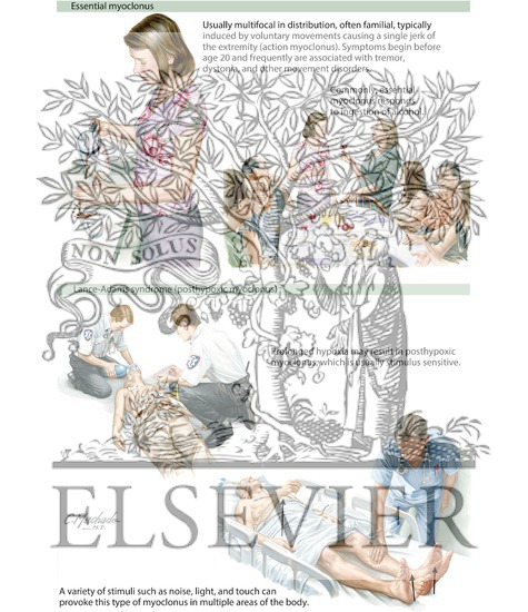 Watermarked preview of labeled image: Myoclonus