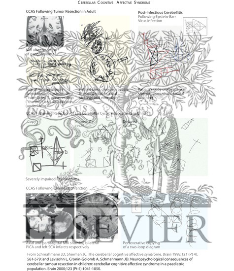 Watermarked preview of unlabeled image: Cerebellar Cognitive Affective Syndrome