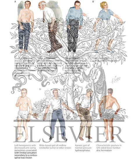 Watermarked preview of labeled image: Gait Disorders