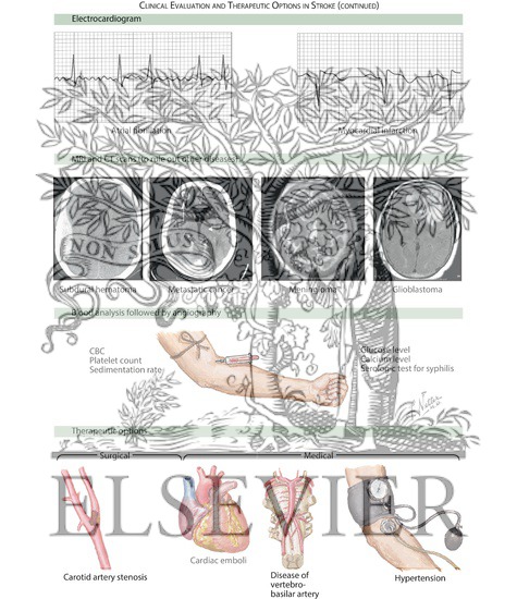 Watermarked preview of labeled image: Clinical Evaluation and Therapeutic Options in Stroke (Continued)