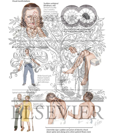 Watermarked preview of unlabeled image: Multiple Sclerosis: Clinical Manifestations