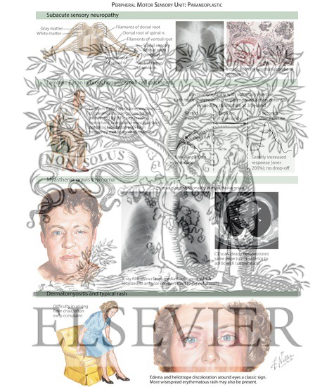 Neuroimmunology: Paraneoplastic and Other Autoimmune SyndromesâPeripheral Motor Sensory Unit