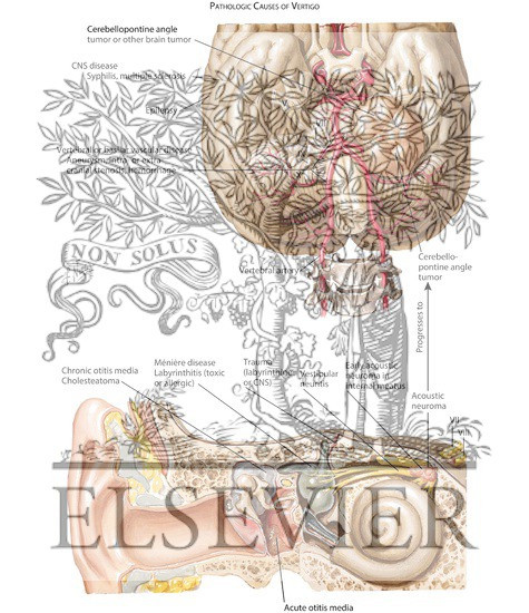 Watermarked preview of labeled image: The Many Pathologic Causes of Vertigo