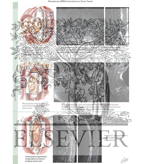 Watermarked preview of labeled image: Myelographic and CT Characteristics of Spinal Tumors