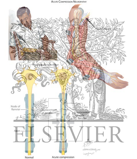 Watermarked preview of labeled image: Compression Neuropathies