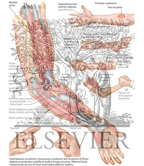 Watermarked preview of labeled image: Proximal Compression of Median Nerve