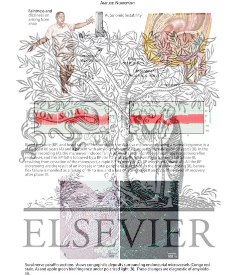 Watermarked preview of labeled image: Monoclonal Protein Associated Neuropathies: Amyloid Neuropathy