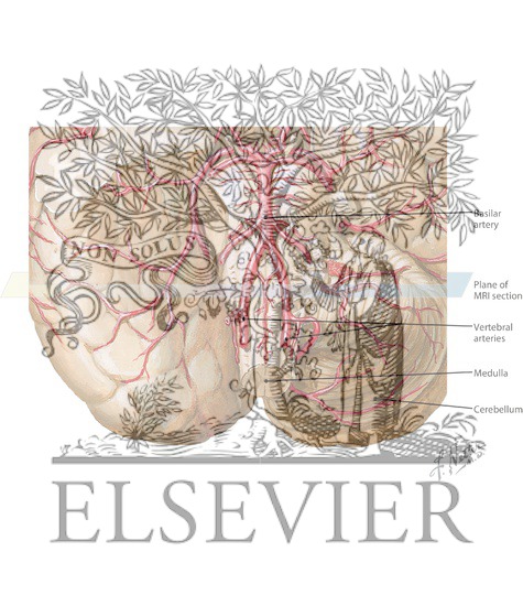 Watermarked preview of labeled image: Basilar and Vertebral Arteries