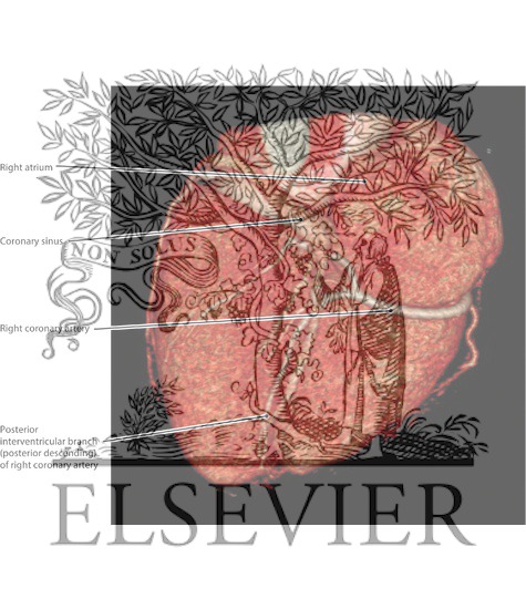 Watermarked preview of labeled image: Heart, Posterior View