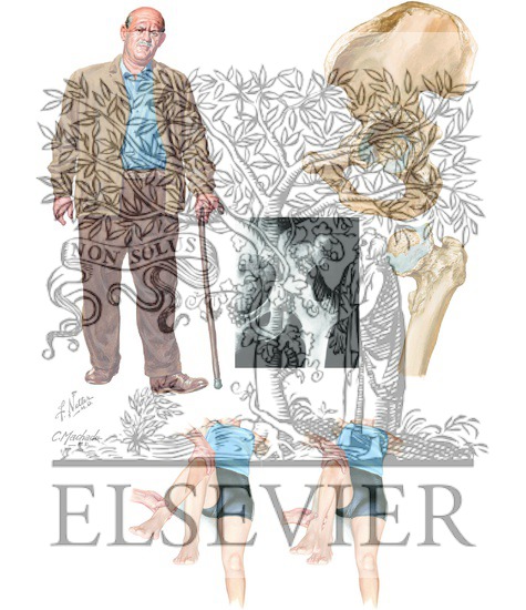 Watermarked preview of unlabeled image: Hip Joint Involvement in Osteoarthritis 