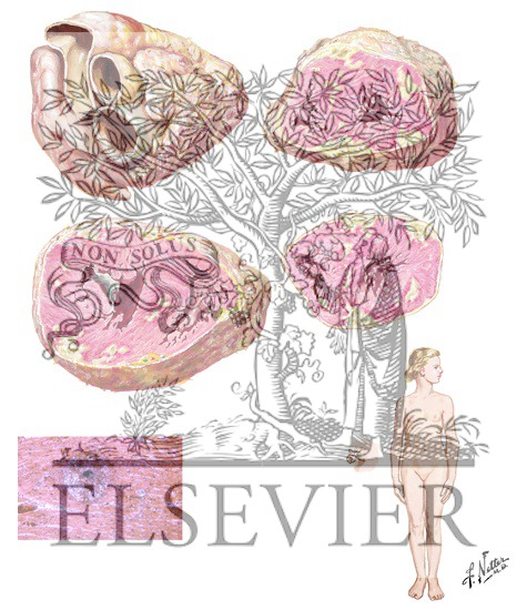 Watermarked preview of unlabeled image: Septic Myocarditis