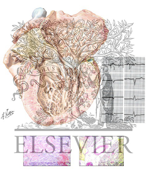 Watermarked preview of unlabeled image: Cardiac Involvement in Amyloidosis: Restrictive Cardiomyopathy