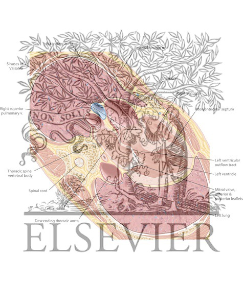Cardiac MR 3-Chamber 1