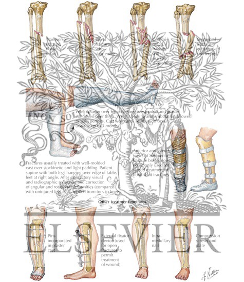 Watermarked preview of labeled image: Fracture of Shaft of Tibia
Trauma of the Leg and Knee