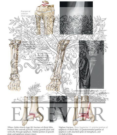 Watermarked preview of labeled image: Fracture of Tibia in Children