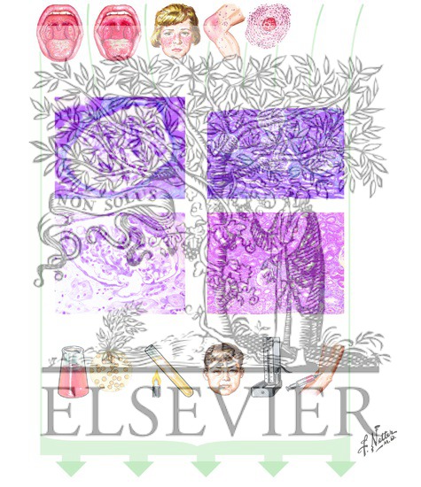Focal Segmental Glomerulonephritis