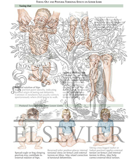 Watermarked preview of labeled image: Rotational Deformities of Lower Limb: Toeing Out