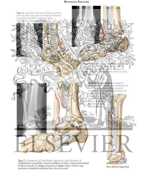 Watermarked preview of labeled image: Rotational Fracture of Ankle Mortise