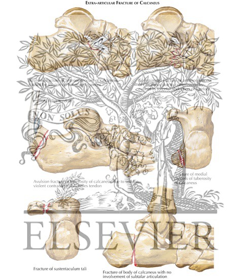 Watermarked preview of labeled image: Extraarticular Fracture of Calcaneus