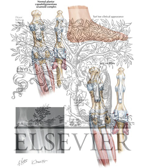 Watermarked preview of labeled image: Turf Toe