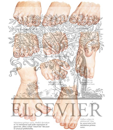 Watermarked preview of labeled image: Congenital Toe Deformities