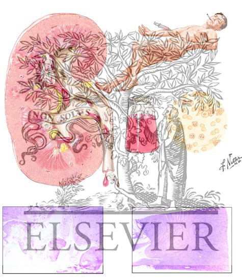 Watermarked preview of unlabeled image: Papillary Necrosis