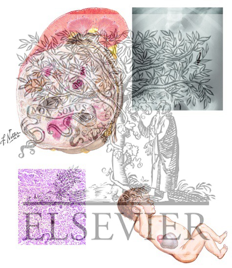 Watermarked preview of unlabeled image: Nephroblastoma