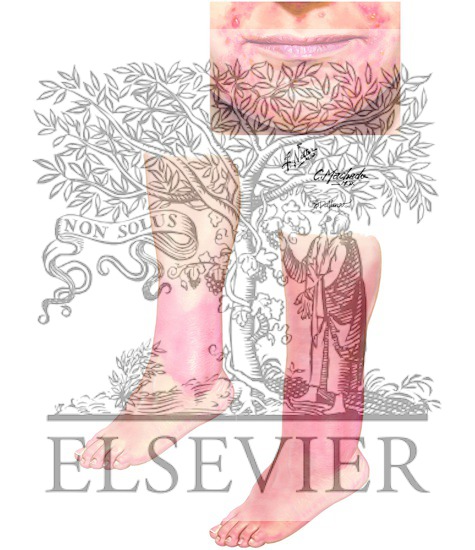 Watermarked preview of unlabeled image: Impetigo, Cellulitis, and Erysipelas