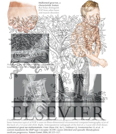 Watermarked preview of labeled image: Fibrodysplasia Ossificans Progressiva