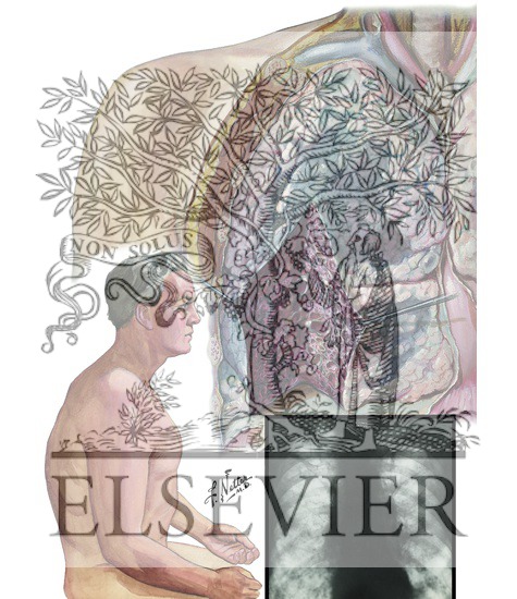 Watermarked preview of unlabeled image: Emphysema